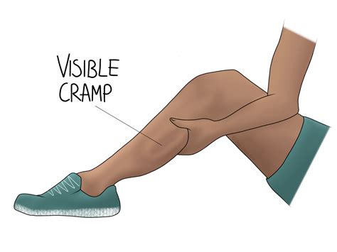 Cramp - Gemini Osteopathy