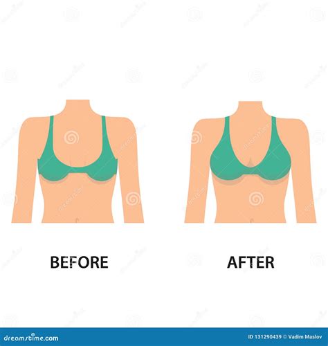 Breast Augmentation before and after Plastic Surgery. Front View of the ...