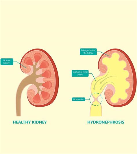 Hydronephrosis In Babies: Symptoms, Causes & Treatment