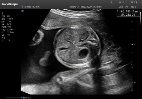 Obstetric Ultrasound