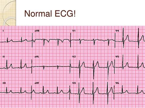 Labelled Diagram Of Ecg