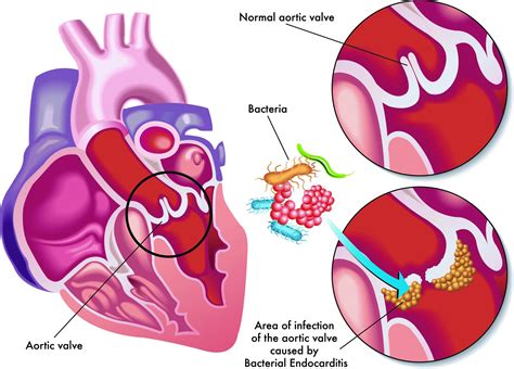 Infective Endocarditis Signs And Symptoms