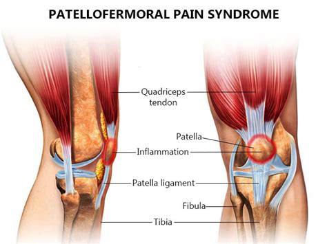 Patellofemoral Pain Syndrome Treatment in NYC | New York Pain Care