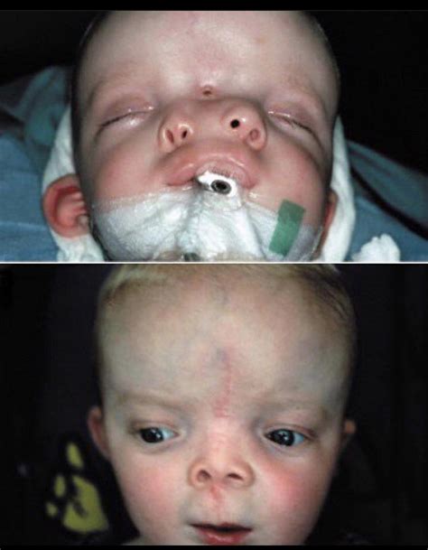 Before and after surgery for craniofacial duplication : r/nursing