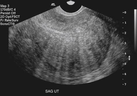 Adenomyosis | Radiology Key