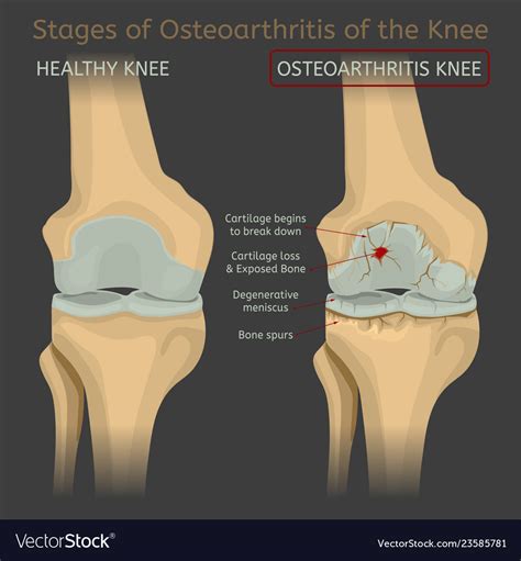 Stages osteoarthritis knee Royalty Free Vector Image