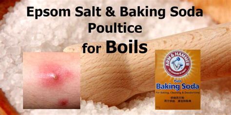 Epsom Salt for Boils - 4 The Best Remedies