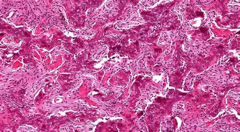 Ossifying Fibroma Tibia