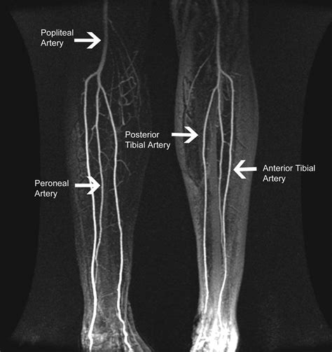 Posterior Tibial Artery Angiogram