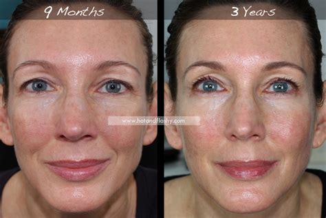 Retin-A for Wrinkles | 3-Year Results | Before & After – hotandflashy.com