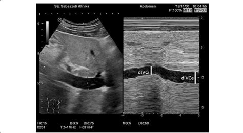 Typical ultrasound image of the inferior vena cava near the heart.... | Download Scientific Diagram