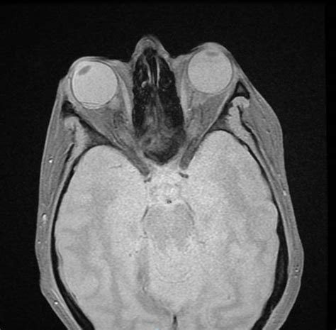 Archives Terson Syndrome Subarachnoid Hemorrhage | neuroangio.org