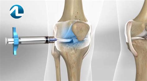 Infiltração articular (viscosuplementação) no tratamento de Condropatias