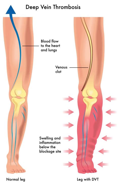 Deep Vein Thrombosis (DVT): Symptoms, Causes, & Treatment