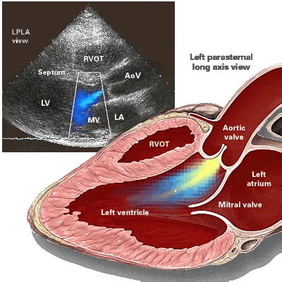 Aortic regurgitation - Symptoms, Causes, and Treatment - Costamedic