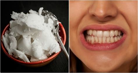 How To Whiten Teeth With Coconut Oil (+12 More Reasons To Put It In Your Mouth)