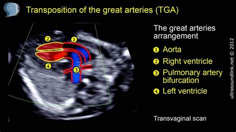 46 best images about Transposition of the Great Arteries; d-TGA & L-TGA (congenitally corrected ...