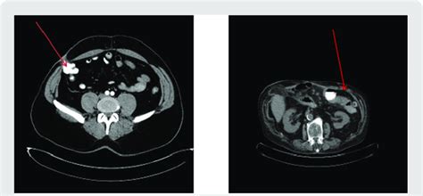 Two cases with colocutaneous fistula. | Download Scientific Diagram