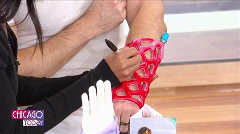 Arm casts with revolutionary design: comfortable, waterproof, and quick application – NBC Chicago