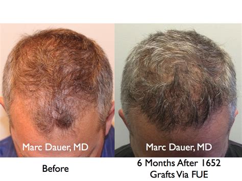 FUE Hair Transplant Results and Donor Zone After 6 Months | Marc Dauer ...