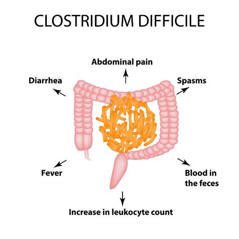 10 Symptoms of Clostridium Difficile Colitis - Facty Health