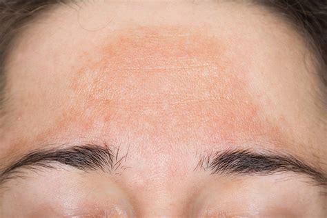 Melasma (Brown Spots or Sun Spots) | Lorna Vanderhaeghe