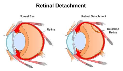 Retinal Detachment - Vitreo-Retinal Consultants