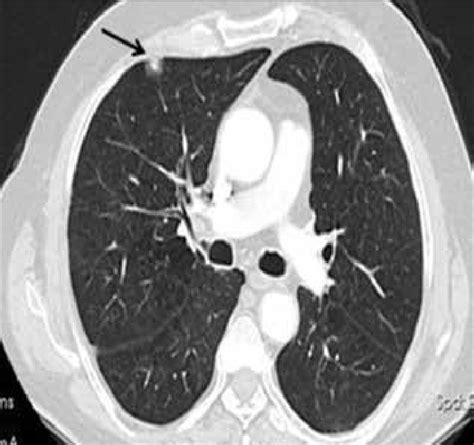 12mm Nodule Lung