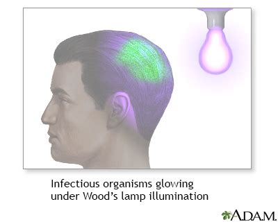 Wood lamp examination