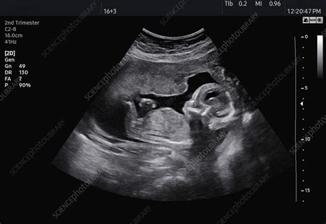 Second trimester foetus, ultrasound scan - Stock Image - C059/2274 ...