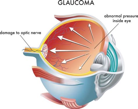 What Is A Glaucoma Suspect? | Fort Lauderdale Eye Institute