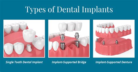 What Is Implant Dentistry? (Discover the Different Types) - Gorman Center for Fine Dentistry