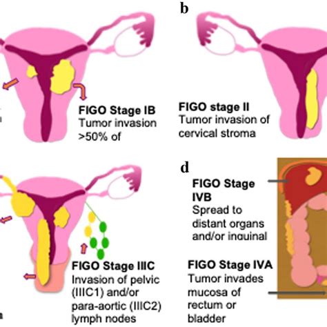 Illustrated FIGO staging system for endometrial cancer. a Stage 1 ...