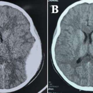 cerebral scan showing a left parietal-temporal extradural hematoma,... | Download Scientific Diagram