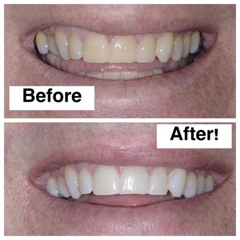 Discover Zoom Teeth Whitening at North Seattle Dental