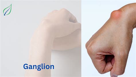 Ganglion Cysts: Causes, Symptoms, and Treatment Options | Best Back Pain, Slip Disc, Knee ...