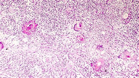 Patients With Post-COVID Cognitive Symptoms May Have Gliosis