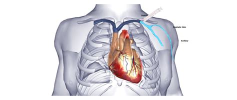 Defibrillator (AICD) Implantation - One Heart Cardiology