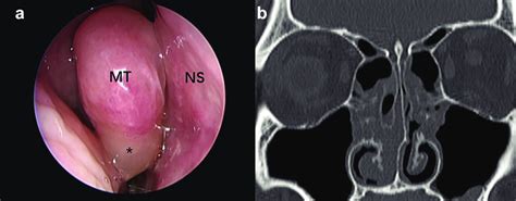 The endoscopic characteristics and radiographic features of central... | Download Scientific Diagram