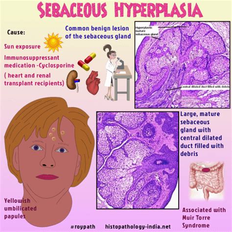 Pathology of Sebaceous Hyperplasia - Dr Sampurna Roy MD