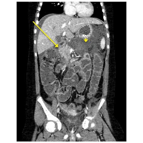 Axial contrast enhanced abdominal CT at the level of the pancreas. The ...