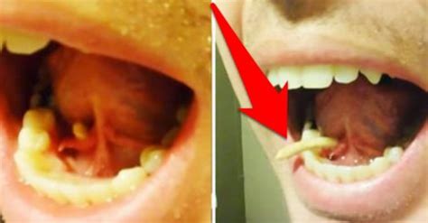 Man Squeezes Out GIANT Salivary Gland Stone From Under His Tongue ...