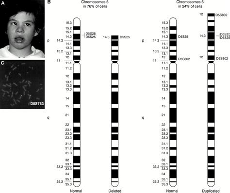 The first three mosaic cri du chat syndrome patients with two rearranged cell lines | Journal of ...