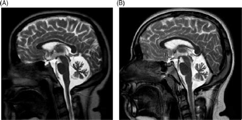 Midsagittal T2-weighted brain MRI of two siblings, a 19-year old woman ...