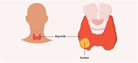 Thyroid neoplasms – types, causes, symptoms, diagnosis. Treatment of ...