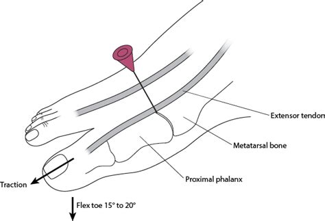 Great Toe Mtp Joint