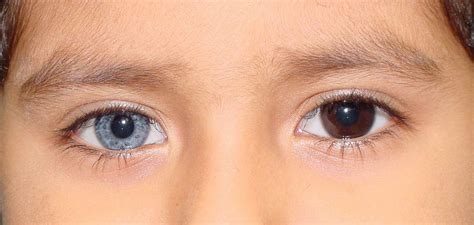 What is Heterochromia? | ReVision LASIK & Cataract Surgery