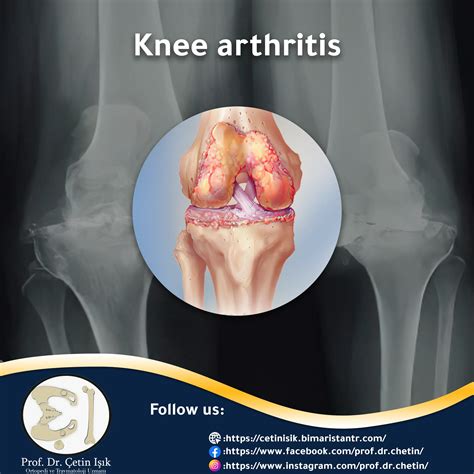 Knee arthritis, the most prominent treatment methods - Dr. What's wrong with you?