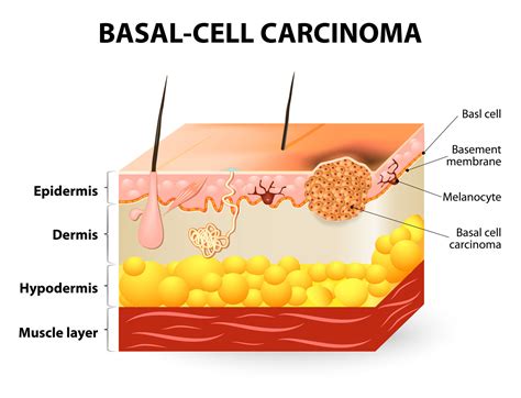 Basal Cell Carcinoma (BCC) - CBD Skin Cancer Clinic