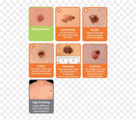 Non Melanoma Skin Cancer Treatment